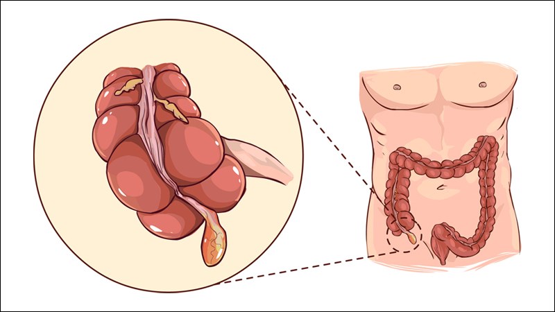 Vị trí ruột thừa trong cơ thể