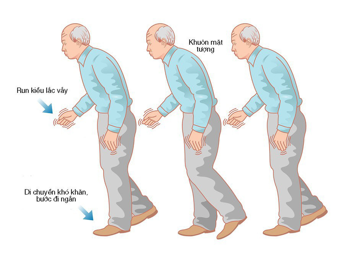 Dấu hiệu bệnh Parkinson