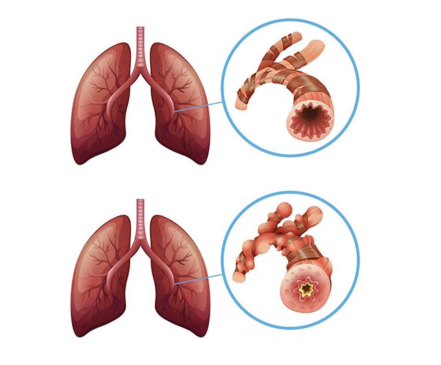 So sánh phổi bình thường và phổi bị viêm