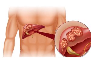 nguyên nhân bilirubin tăng