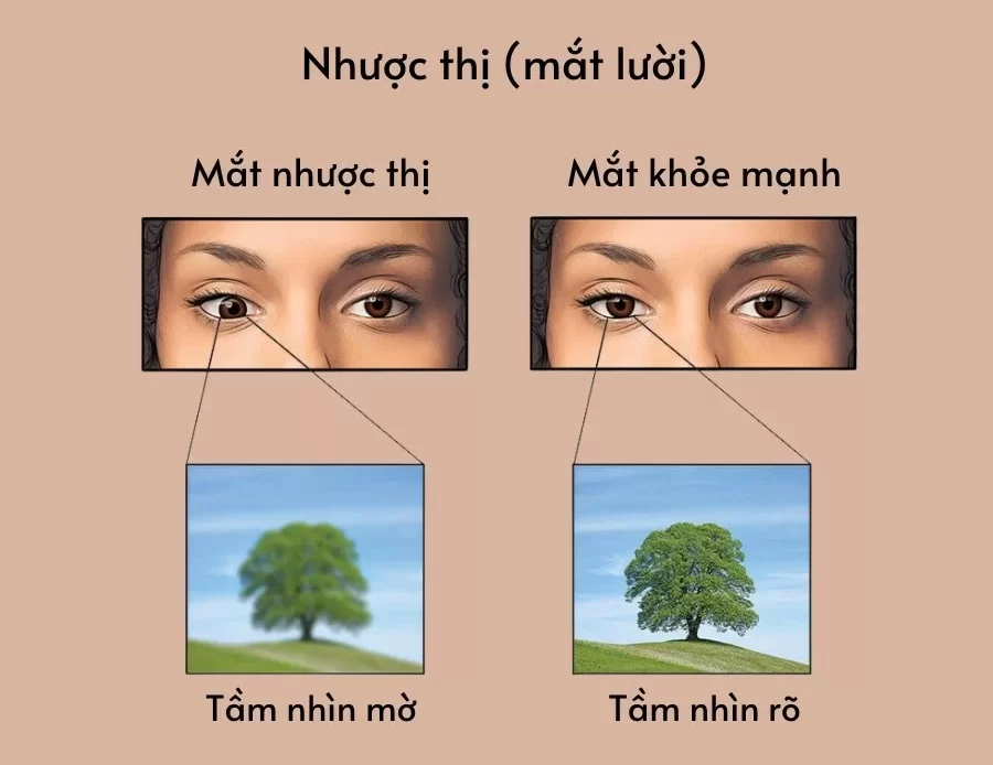 dấu hiệu nhược thị