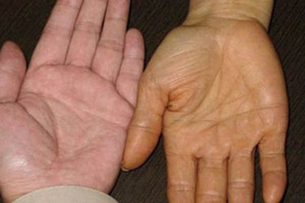 da vàng do bệnh gan