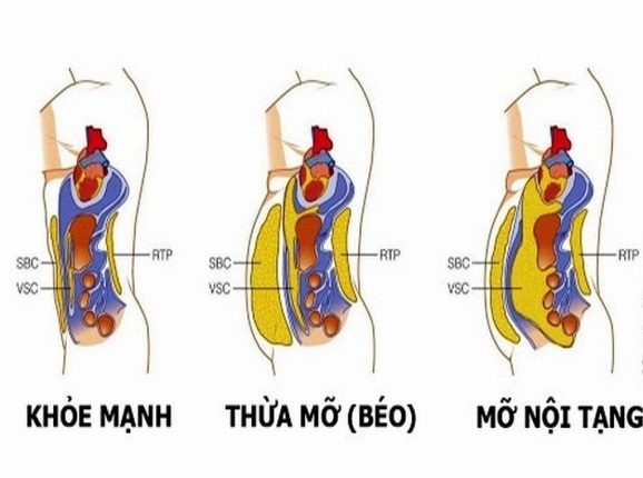 phân biệt mỡ dưới da và mỡ nội tạng