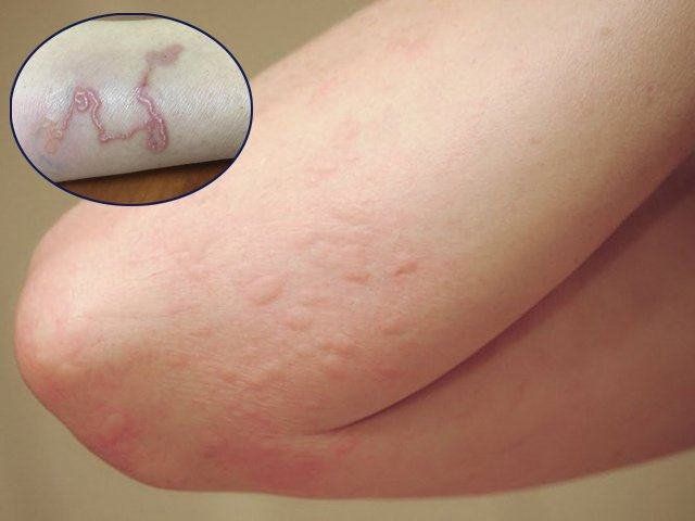 dấu hiệu nhiễm sán chó