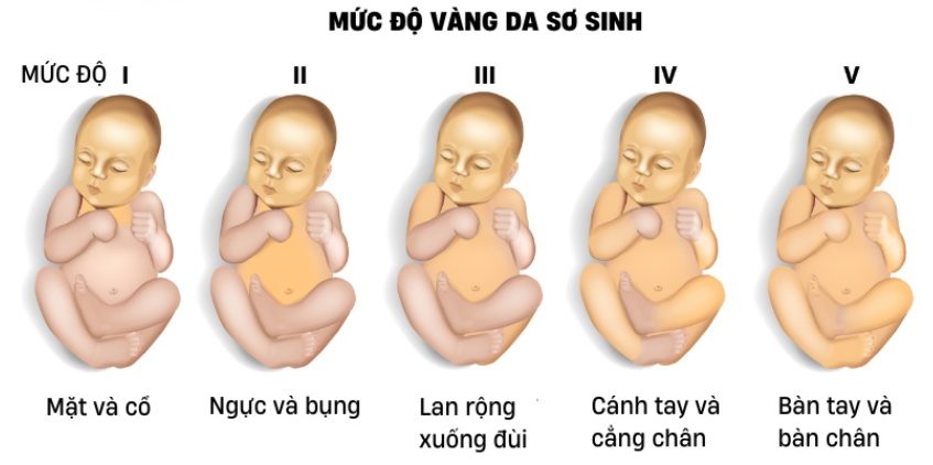 dấu hiệu vàng da