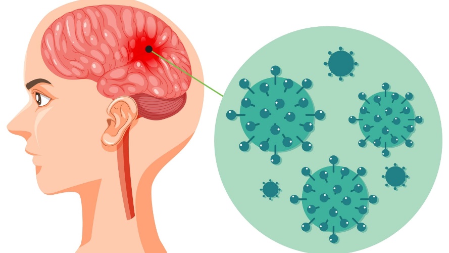 bệnh não mô cầu