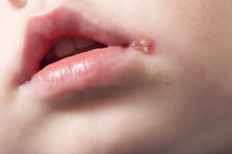 Herpes miệng
