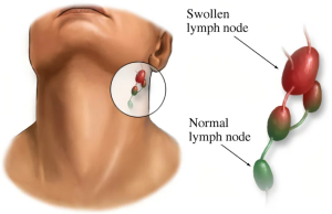 Hạch bạch huyết