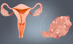 đa nang buồng trứng