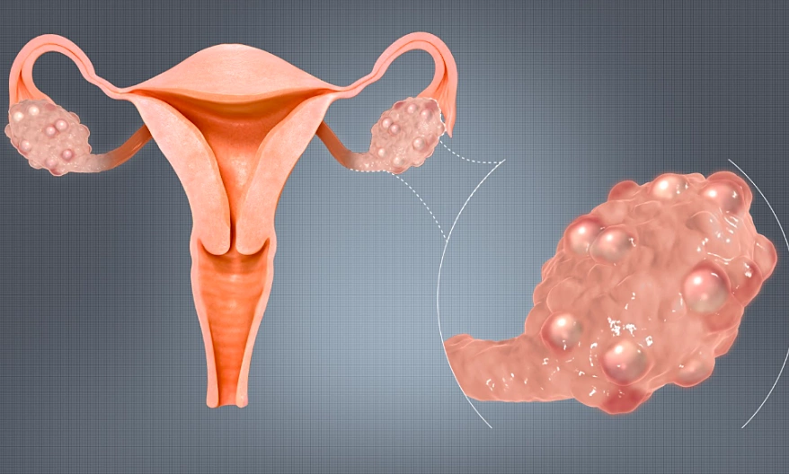 đa nang buồng trứng