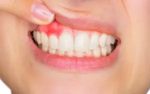 viêm nha chu