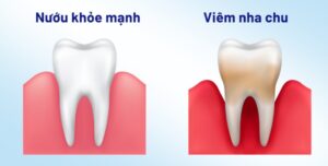 viêm nướu